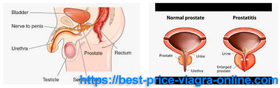 How prostatitis affects potency 